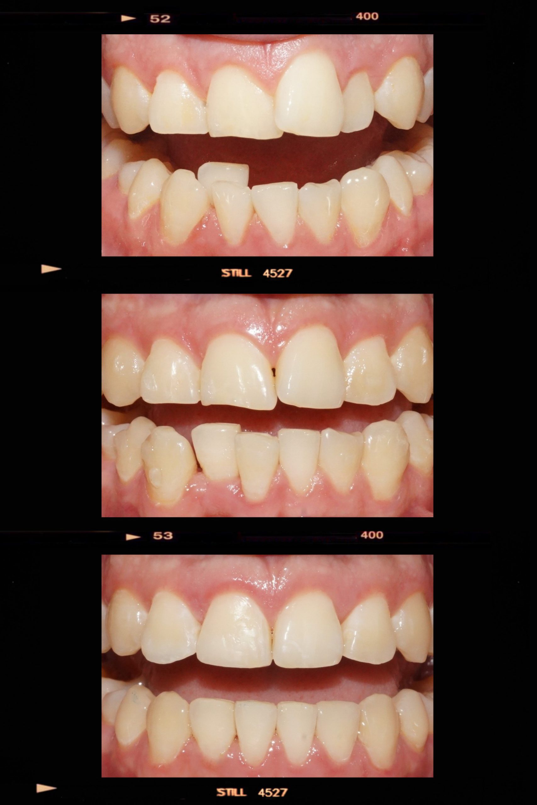 The Life-Changing Power of Orthodontic Treatment with Invisalign