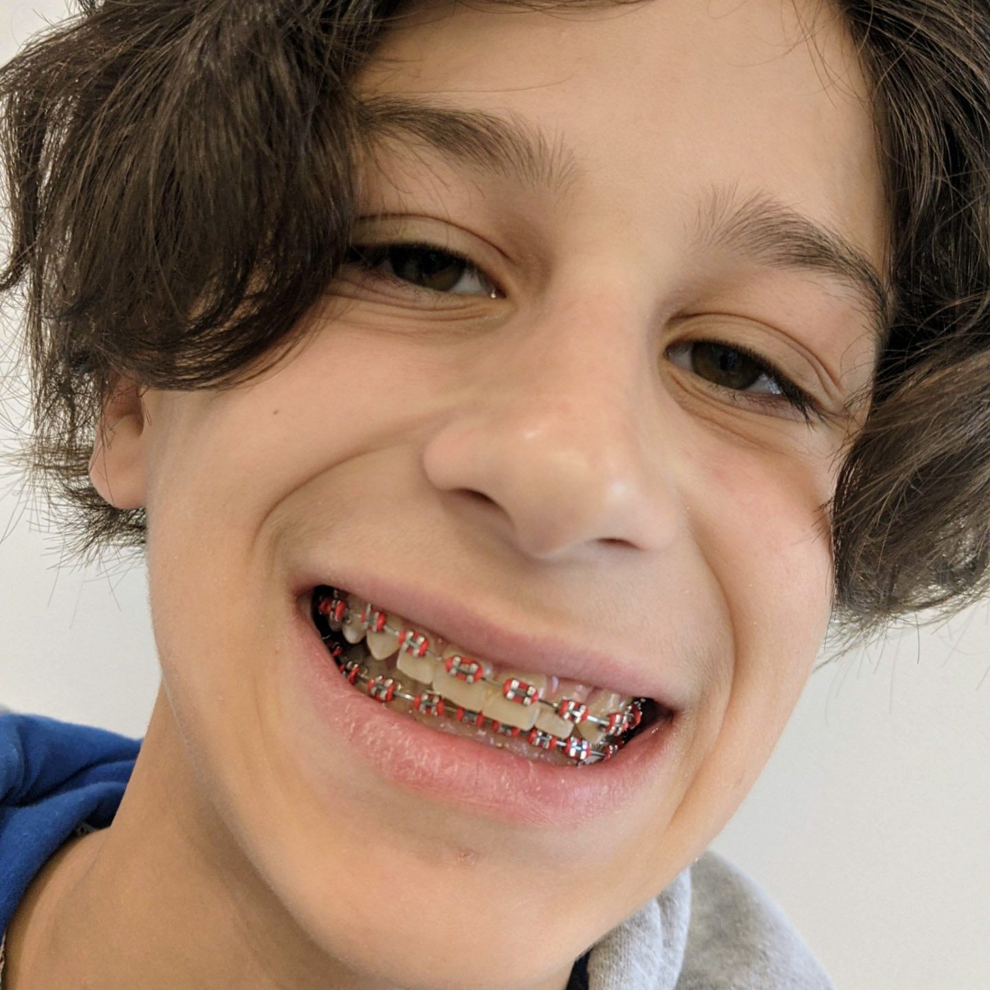 Teen Shows Off Playful Confidence with Braces Personalized Orthodontic Smile: Pink Braces in Style